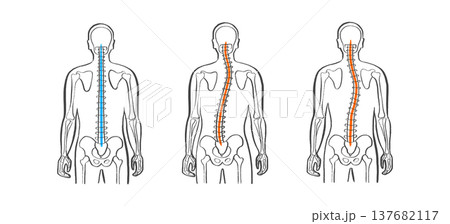 Scoliosis spine deformity 137682117