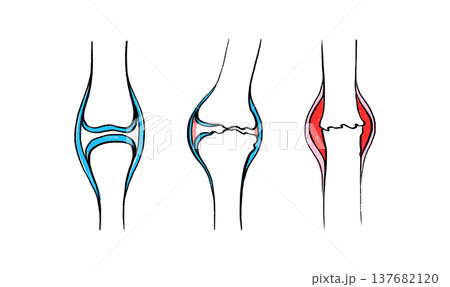 Arthritis Sketch Poster 137682120