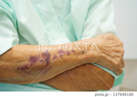 Ecchymosis, elderly bleeding on her arm after taking aspirin. 137696186
