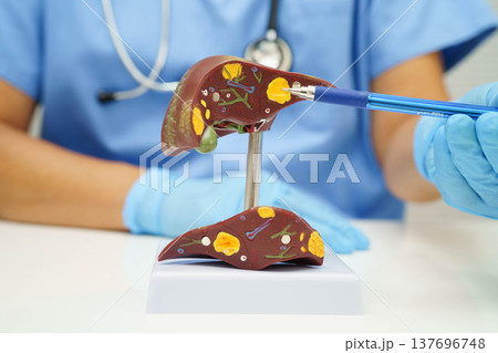 Cirrhosis, Liver cancer, fatty liver, Asian doctor with liver human anatomy model in World Hepatitis Day at hospital. Cirrhosis, Liver cancer, fatty liver, Asian doctor with liver human anatomy model in World Hepatitis Day at hospital. 137696748