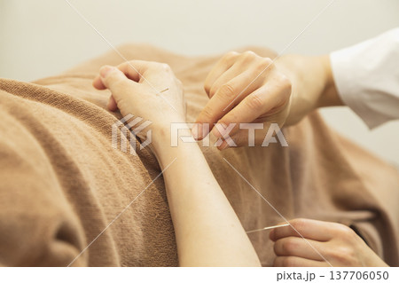 背中への鍼治療を受ける患者と鍼灸師の手元 東洋医学による痛みの緩和とヘルスケア 137706050