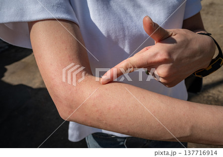 Cropped shot view of woman pointing to her skin after rashes occur. A rash on your arms can occur due to an allergic reaction, contact with irritants, infection, or an underlying medical condition lik Cropped shot view of woman pointing to her skin after rashes occur. A rash on your arms can occur due to an allergic reaction, contact with irritants, infection, or an underlying medical condition lik 137716914