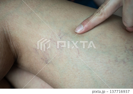 Close up of spider veins occur on woman thigh. Spider veins and Varicose veins are a common condition caused by weak or damaged vein walls and valves. 137716937