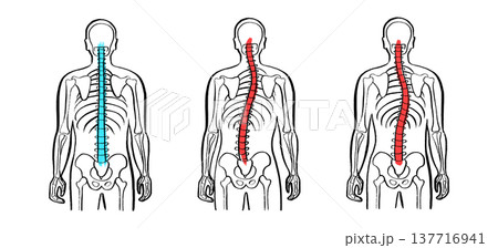 Scoliosis spine deformity 137716941