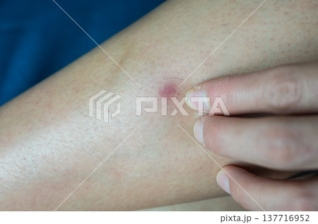 Close up of a red rash (or bruise) occur on woman thigh. Rash is a symptom that causes the affected area of skin to turn red and blotchy and to swell. 137716952