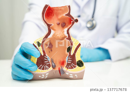 Asian doctor with rectum and hemorrhoid human anatomy model at hospital, inflamed vascular structure. Asian doctor with rectum and hemorrhoid human anatomy model at hospital, inflamed vascular structure. 137717678