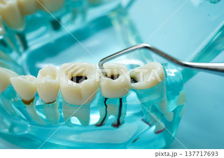 Teeth dental model with tool for dentist use to cleaning care treatment. Teeth dental model with tool for dentist use to cleaning care treatment. 137717693