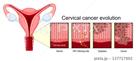 Cervical cancer evolution. Close-up of Normal cell, Human papillomavirus infection HPV infecting cells, Dysplasia and Cancer. 137727802