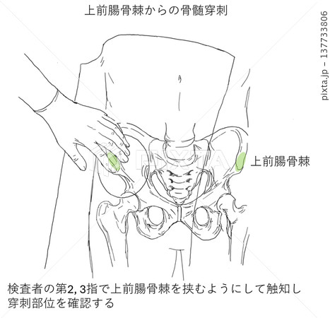 上前腸骨棘からの骨髄穿刺 触診法 137733806