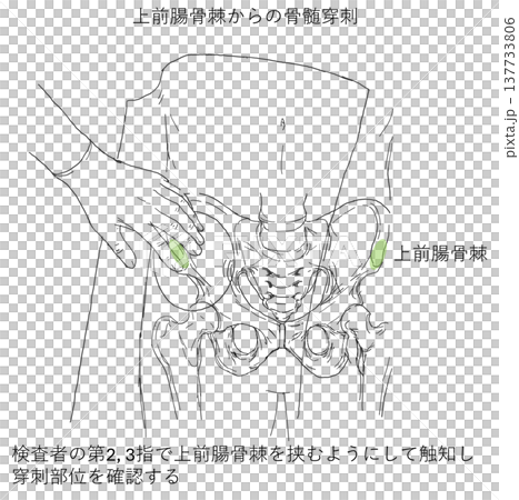經髂前上棘觸診法行骨髓穿刺術 137733806