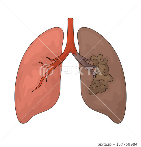 Illustration of Lungs Cancer Illustration of Lungs Cancer 137759984