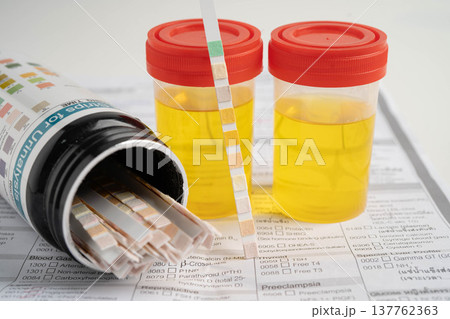 Urinalysis, urine cup with reagent strip pH paper test and comparison chart in laboratory. Urinalysis, urine cup with reagent strip pH paper test and comparison chart in laboratory. 137762363