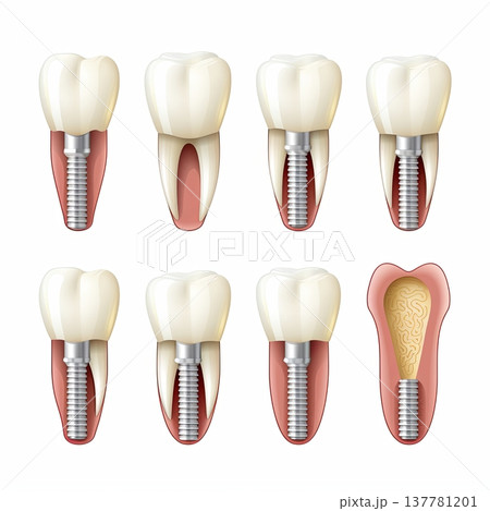 Dental Implant Procedure Stages Illustration of Tooth Replacement and Bone Integration Process Dental Implant Procedure Stages Illustration of Tooth Replacement and Bone Integration Process 137781201