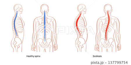 Scoliosis spine deformity 137799754