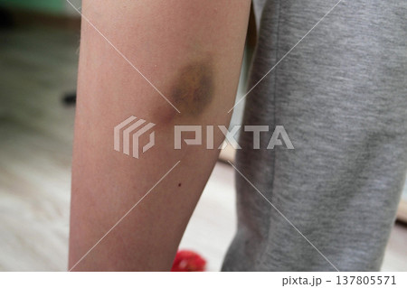 Closeup of hands applying balm to leg. Knee injury, skin hematoma, skin repair concept. slow motion Closeup of hands applying balm to leg. Knee injury, skin hematoma, skin repair concept. slow motion 137805571