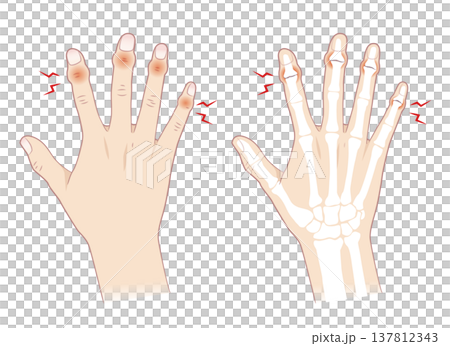 Symptoms of Heberden's nodes, the right hand and its bones Symptoms of Heberden's nodes, the right hand and its bones 137812343