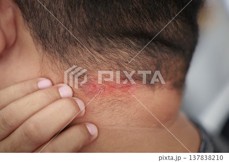 Close up of a man touching an itchy red rash and skin irritation on the back of his neck at the hairline. Concept of dermatology, allergy, eczema, psoriasis, fungal infection or skin disease. Close up of a man touching an itchy red rash and skin irritation on the back of his neck at the hairline. Concept of dermatology, allergy, eczema, psoriasis, fungal infection or skin disease. 137838210
