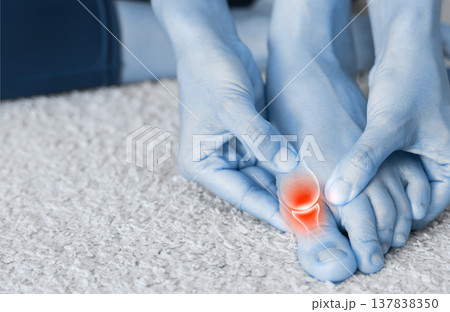 Close up of woman massaging painful big toe with anatomical joint illustration and red highlight. Hallux valgus, gout, bunion and bone inflammation concept for medical health care. 137838350