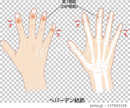 赫伯登結節、右手及其骨骼的症狀 137843326