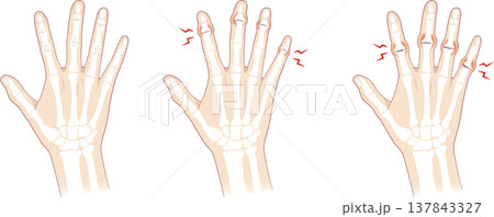 正常な手指とへバーデン結節、ブシャール結節の骨 137843327