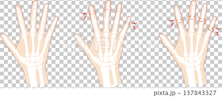 正常的手指和骨骼,包括赫伯登結節和布沙爾結節。 正常的手指和骨骼,包括赫伯登結節和布沙爾結節。 137843327