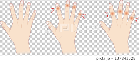 Normal fingers and Heberden's nodes, Bouchard's nodes Normal fingers and Heberden's nodes, Bouchard's nodes 137843329