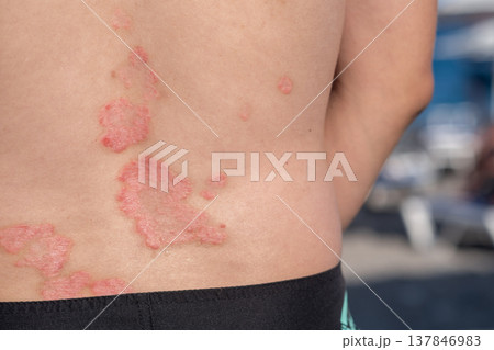 A person stands with visible psoriasis patches on their back, enjoying a beach atmosphere while surrounded by sun and relaxation. A person stands with visible psoriasis patches on their back, enjoying a beach atmosphere while surrounded by sun and relaxation. 137846983