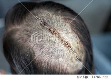 Close up of surgical scar with staples on head after craniotomy for brain tumor removal. Neurosurgery recovery and postoperative healing concept. Close up of surgical scar with staples on head after craniotomy for brain tumor removal. Neurosurgery recovery and postoperative healing concept. 137861566