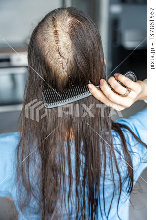 Woman carefully combing hair near surgical scar with staples after craniotomy for brain tumor removal. Postoperative care and recovery routine concept. 137861567