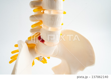 Lumbar spine displaced herniated disc fragment, spinal nerve and bone. Model for treatment medical in the orthopedic department. 137862140