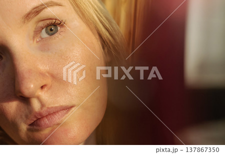 Close-up of female face with enlarged pores and oily skin, visible texture, redness on chin. Natural light beauty portrait, skincare concerns, dermatology concept. Close-up of female face with enlarged pores and oily skin, visible texture, redness on chin. Natural light beauty portrait, skincare concerns, dermatology concept. 137867350