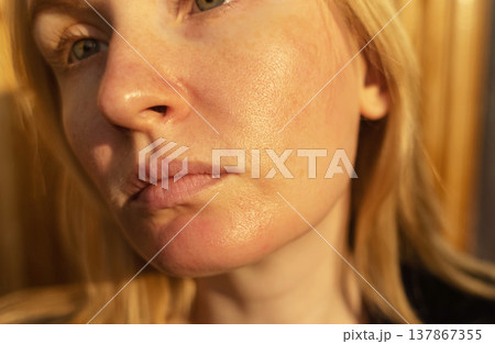 Close-up of female face with enlarged pores and oily skin, visible texture, redness on chin. Natural light beauty portrait, skincare concerns, dermatology concept. Close-up of female face with enlarged pores and oily skin, visible texture, redness on chin. Natural light beauty portrait, skincare concerns, dermatology concept. 137867355