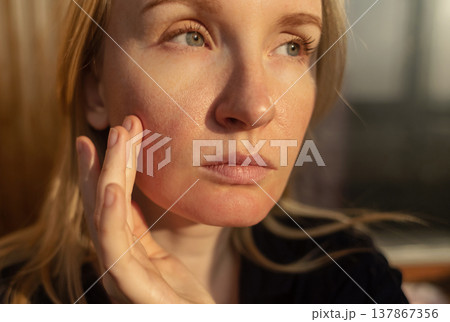 Close-up of female face with enlarged pores and oily skin, visible texture, redness on chin. Natural light beauty portrait, skincare concerns, dermatology concept. Close-up of female face with enlarged pores and oily skin, visible texture, redness on chin. Natural light beauty portrait, skincare concerns, dermatology concept. 137867356