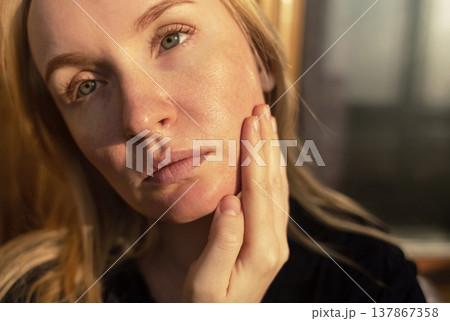 Close-up of female face with enlarged pores and oily skin, visible texture, redness on chin. Natural light beauty portrait, skincare concerns, dermatology concept. Close-up of female face with enlarged pores and oily skin, visible texture, redness on chin. Natural light beauty portrait, skincare concerns, dermatology concept. 137867358