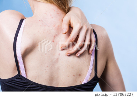 Woman with skin problem acne on back 137868227