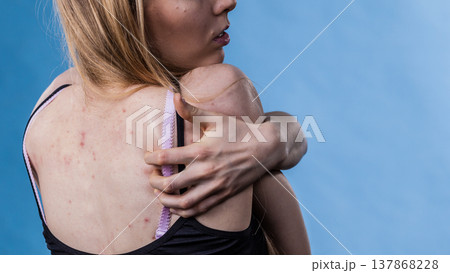 Woman with skin problem acne on back 137868228