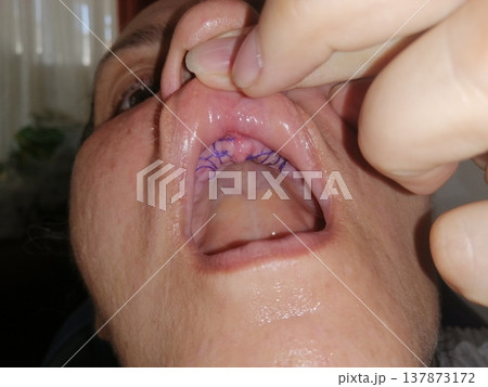 A man with an open mouth and missing all his teeth. Medical sutures on the upper jaw, preparing the oral cavity for dental implants. A man with an open mouth and missing all his teeth. Medical sutures on the upper jaw, preparing the oral cavity for dental implants. 137873172