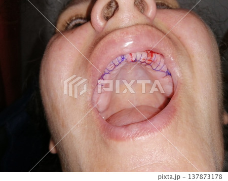 A man with an open mouth and missing all his teeth. Medical sutures on the upper jaw, preparing the oral cavity for dental implants. 137873178