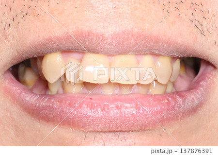Close up of front teeth used for orthodontic evaluation before treatment showing alignment, spacing, and bite condition in a natural smile in March 2026 137876391