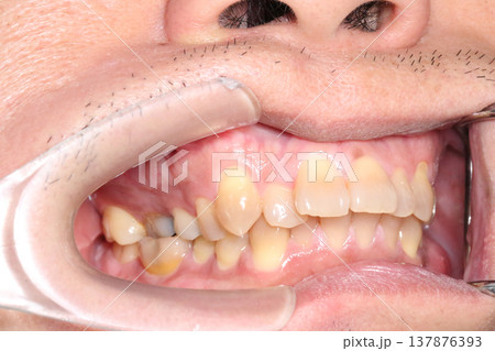 Close up of misaligned teeth and uneven bite inside the mouth showing dental crowding and irregular tooth position recorded in March 2026. Close up of misaligned teeth and uneven bite inside the mouth showing dental crowding and irregular tooth position recorded in March 2026. 137876393