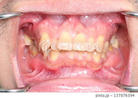 Close up of misaligned teeth and uneven bite inside the mouth showing dental crowding and irregular tooth position recorded in March 2026. Close up of misaligned teeth and uneven bite inside the mouth showing dental crowding and irregular tooth position recorded in March 2026. 137876394