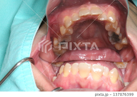 Close up intraoral view using a dental mirror to capture inner teeth and palate showing occlusal surface and detailed oral structure in a clinical setting. Close up intraoral view using a dental mirror to capture inner teeth and palate showing occlusal surface and detailed oral structure in a clinical setting. 137876399