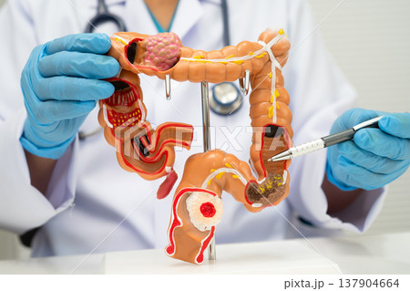 Colorectal cancer, doctor holding intestine colon human anatomy model. 137904664