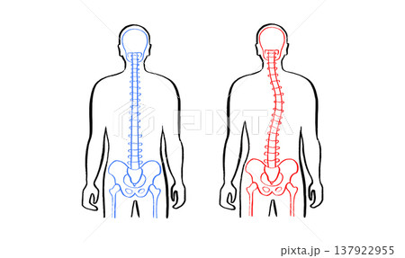 Scoliosis spine deformity Scoliosis spine deformity 137922955