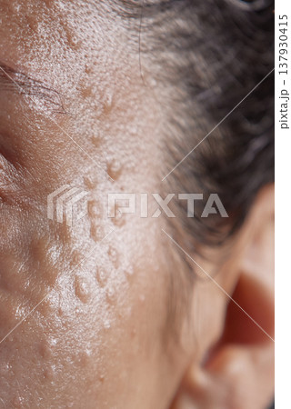 Injectable cosmetology. Facial biorevitalization procedure using a hyaluronic acid-based product. Papules on female face after biorevitalization. close-up 137930415