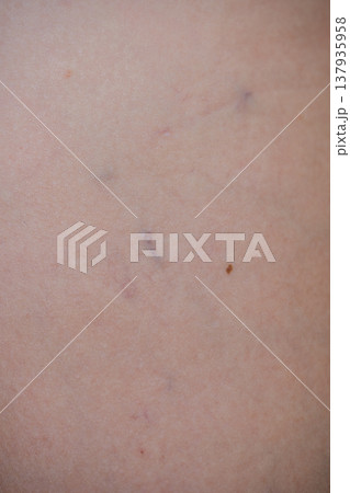 Shallow Injury On Skin With Minor Swelling Close To Mole For Recovery Assessment Shallow Injury On Skin With Minor Swelling Close To Mole For Recovery Assessment 137935958