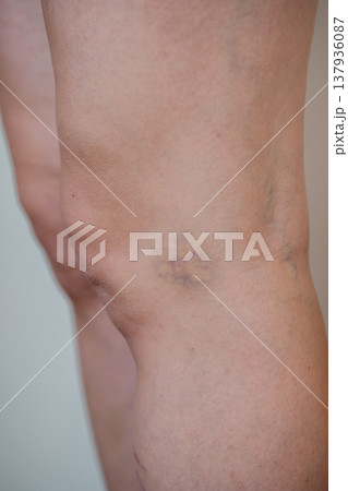 Clinical Evaluation Focusing On Skin Texture And Color Changes In Knee Bruise Area Clinical Evaluation Focusing On Skin Texture And Color Changes In Knee Bruise Area 137936087