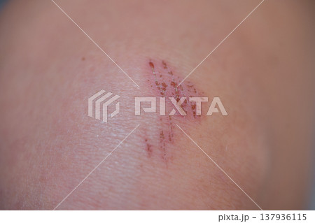 High Detail Description Of Knee Abrasion Caused By Outdoor Fall With Medical Context High Detail Description Of Knee Abrasion Caused By Outdoor Fall With Medical Context 137936115