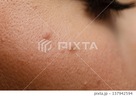 Part of woman face with mole close up Part of woman face with mole close up 137942594