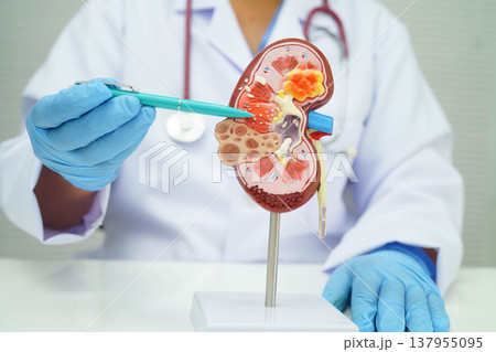 Chronic kidney disease, Asian woman with model for treatment urinary system, urology, Estimated glomerular filtration rate eGFR. 137955095